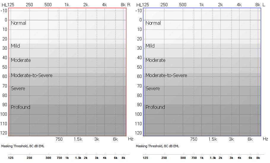 Image of hearing levels on an audiogram. (Symbols used are based on British Society of Audiology (BSA) guidelines.) Image courtesy of Roulla Katiri, Chief Audiologist, Audiology Department, Mater Misericordiae University Hospital, Dublin, Ireland